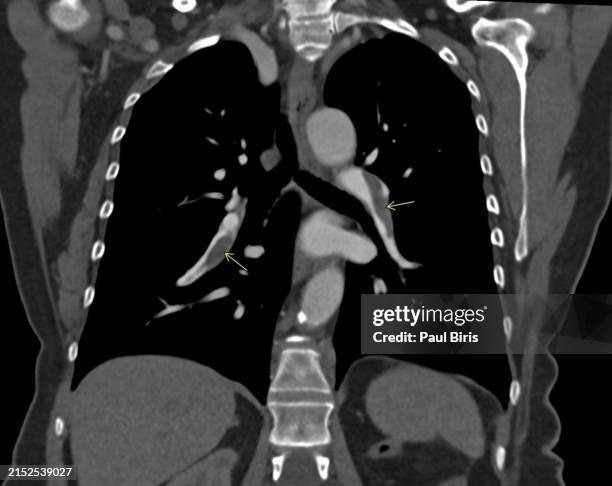 Ctpe 390 Pulmonary Embolism Stock Photos, High-Res Pictures, and Images ...