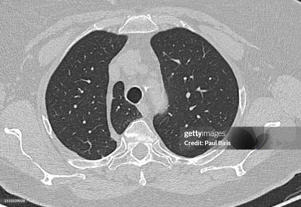 Azygos fissure and azygos lobe A Rare Anatomical Variant seen on CT of the lung CAT Scan