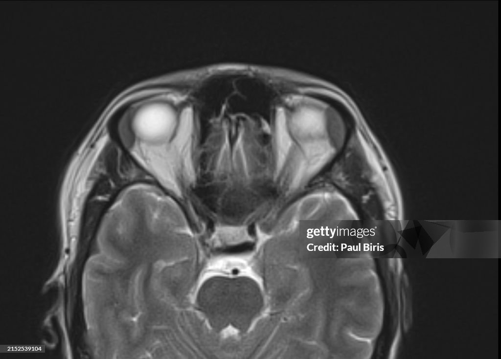 Lacrimal Gland Enlargement billateral seen on MRI axial T2 image