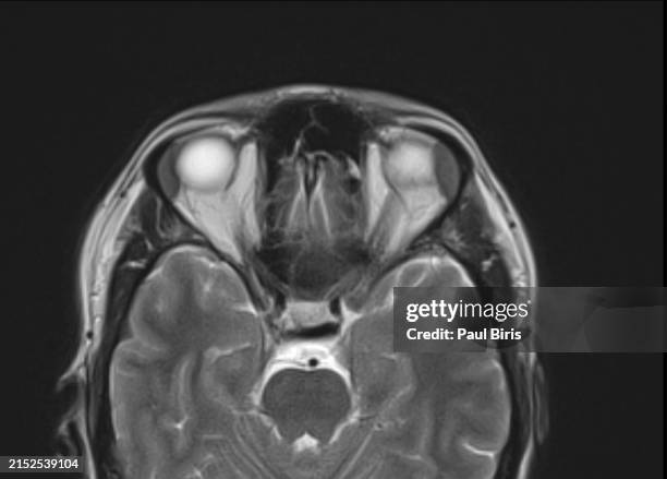 lacrimal gland enlargement billateral seen on mri axial t2 image - canaliculi stock pictures, royalty-free photos & images