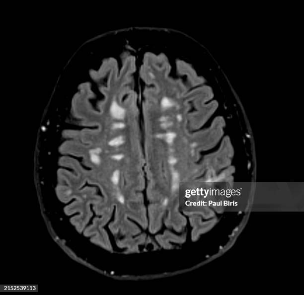 magnetic resonance imaging in multiple sclerosis on axial flair image of the brain - myelin sheath stock pictures, royalty-free photos & images