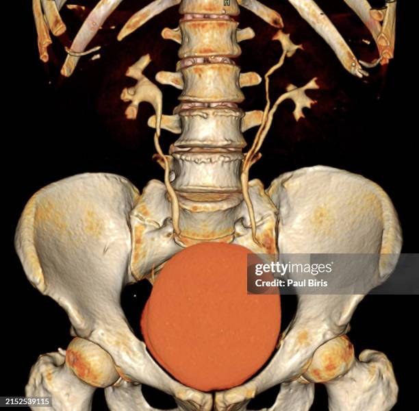 duplicated collecting system and one distal ureter on the left - 3d computer tomography reconstruction - urethritis stock pictures, royalty-free photos & images