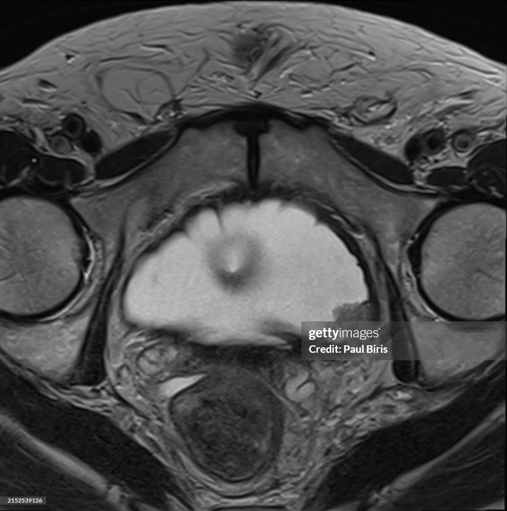 Detecting Bladder Cancer with a CT Scan on the left wall