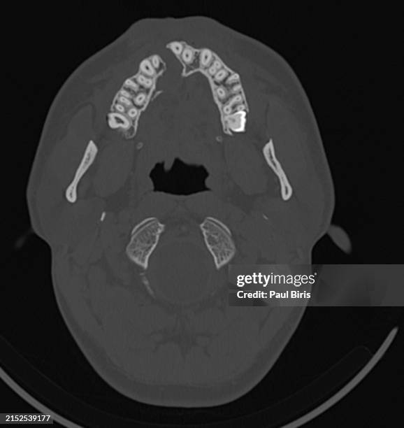 typical cleft lip and cleft palate seen on ct images - tomography stock pictures, royalty-free photos & images