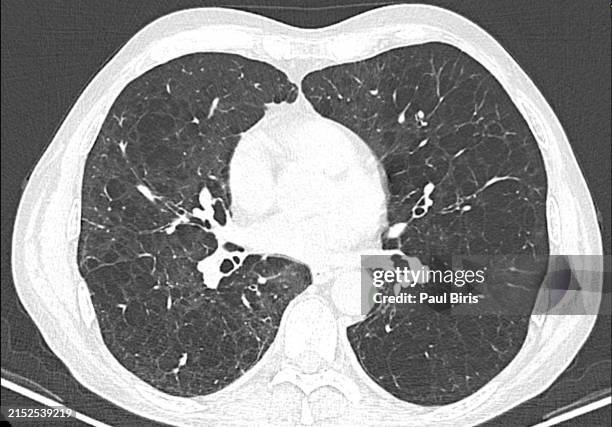 pulmonary emphysema on computed tomography in smokers - emphysema stock pictures, royalty-free photos & images