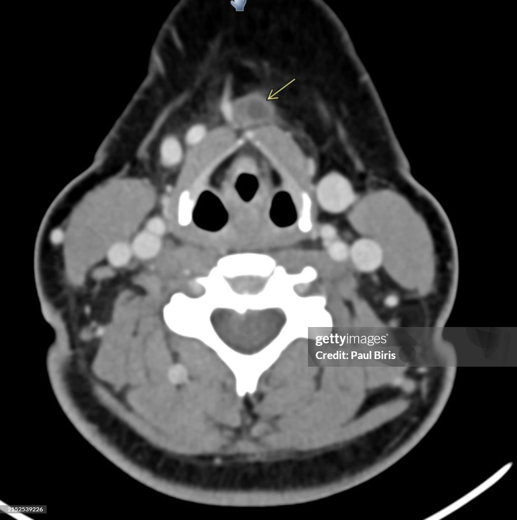 The CT Appearance of Thyroglossal duct cyst (TDC) axial view