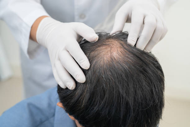 Hair Transplantation in the U.S.: Restore Your Confidence and Your Hair