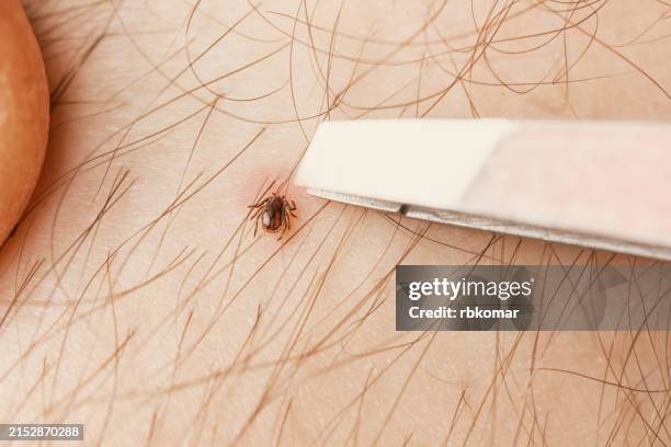 tick removal in progress - close-up view of a tick being extracted from human skin with tweezers - tique brune du chien photos et images de collection