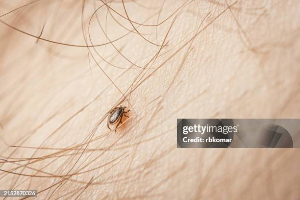 tick embedded in human skin, potential lyme disease and encephalitis risk - deer tick stock pictures, royalty-free photos & images