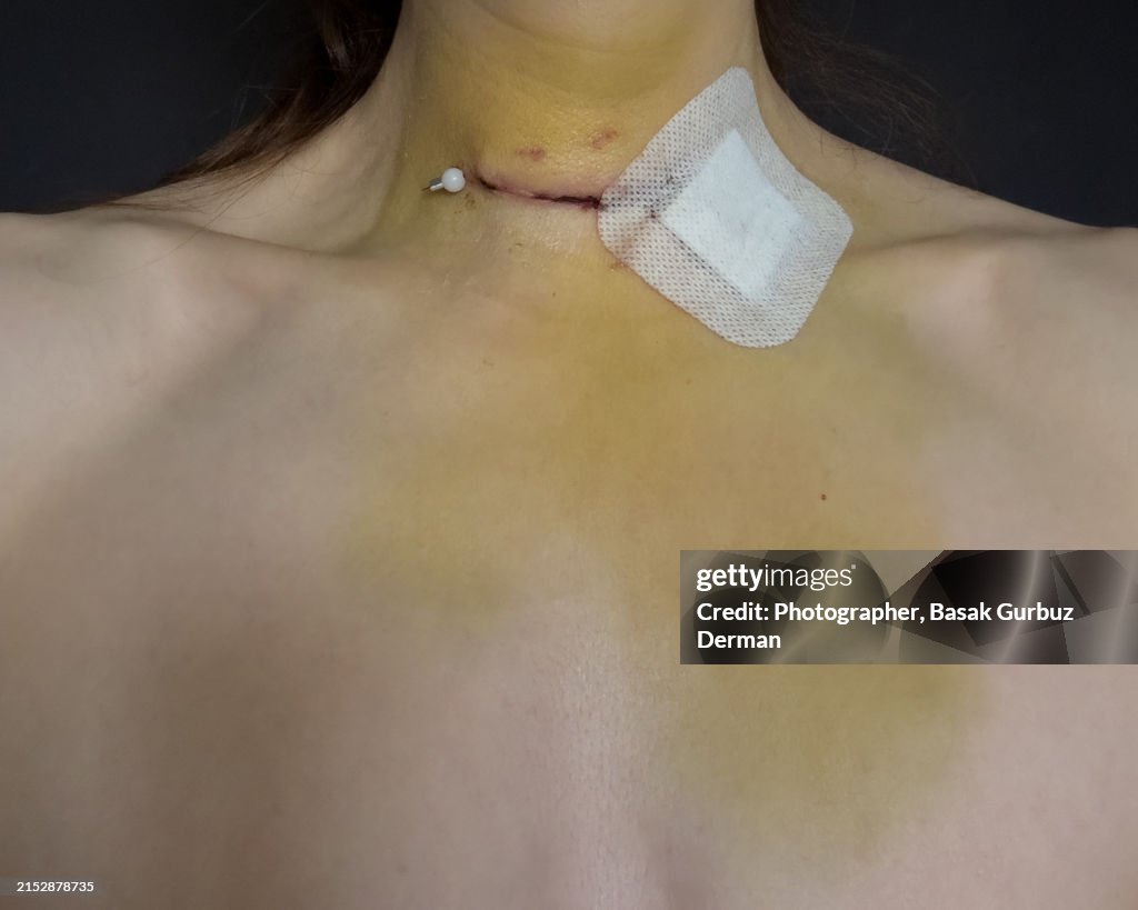 Skin wound, sutures, and bandage on neck; bruises on neck and chest after thyroidectomy