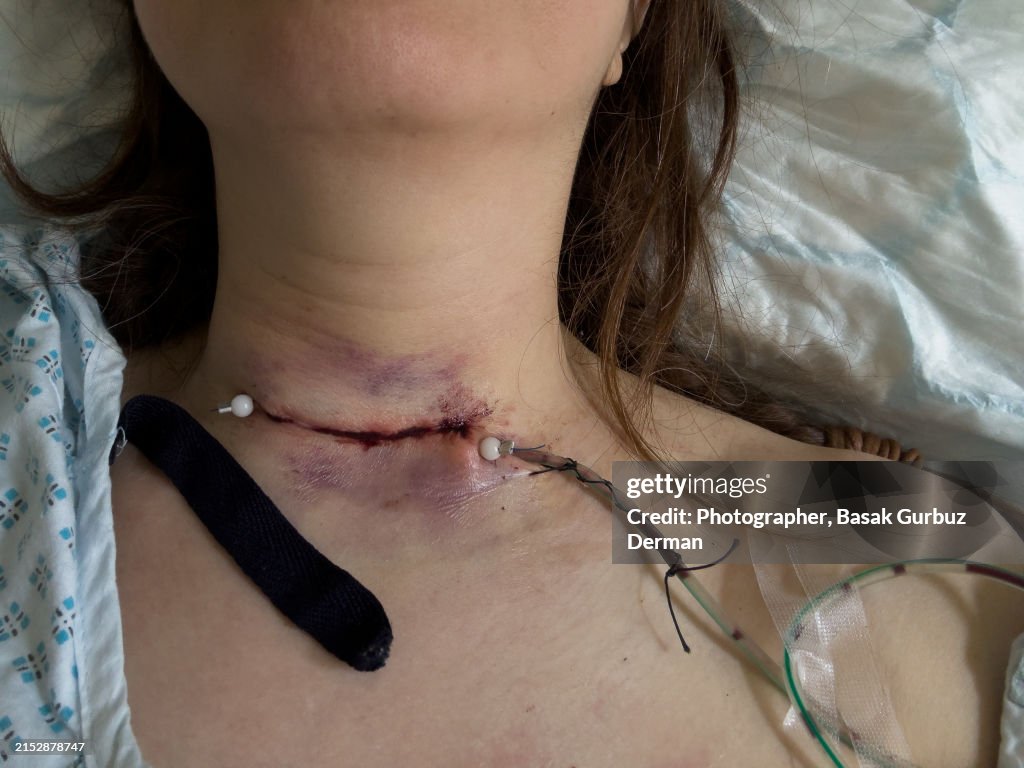 Sutures and surgical drain on a human neck after thyroidectomy