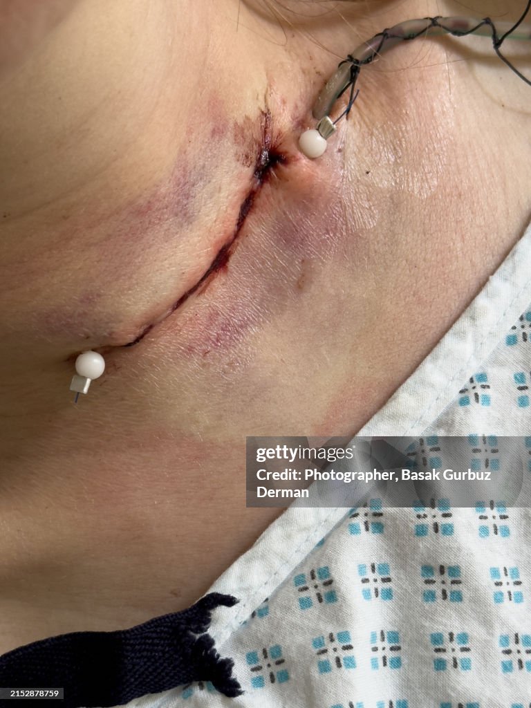 Sutures and surgical drain on a human neck after thyroidectomy