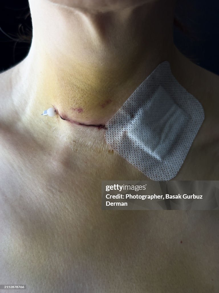 Skin wound, sutures, and bandage on neck; bruises on neck and chest after thyroidectomy