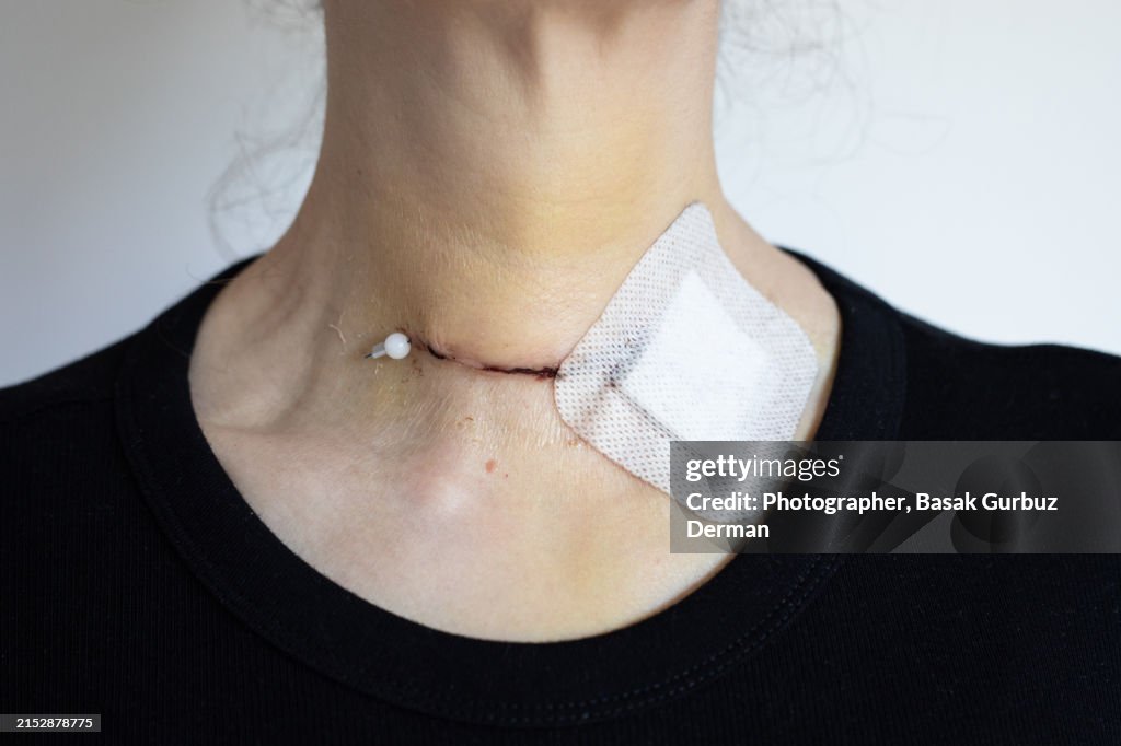 Skin wound, sutures, and bandage on neck; bruises on neck and chest after thyroidectomy