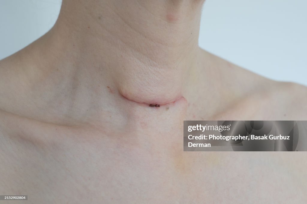 Recovering from thyroidectomy operation. Surgery wound and red skin on a human neck