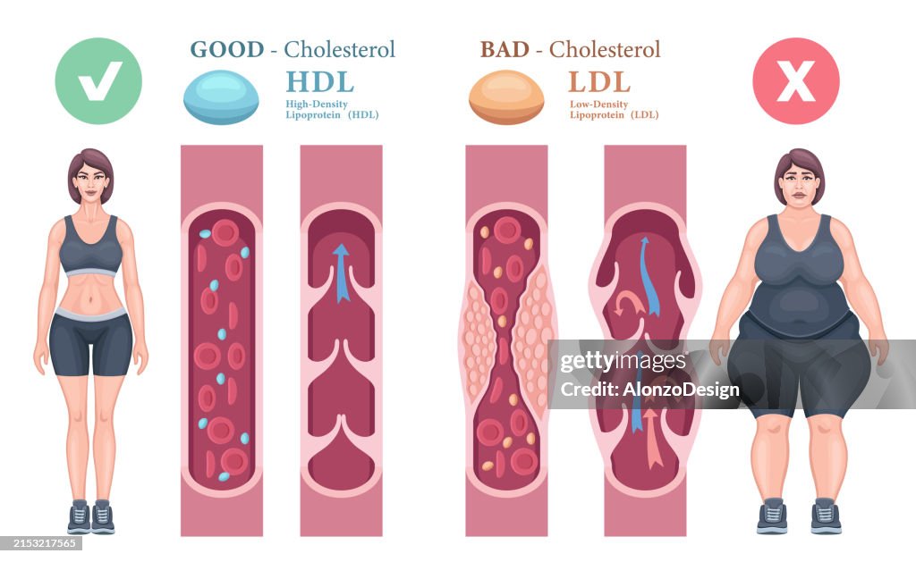 Arteria normal y arteria bloqueada por el colesterol. Arterias obstruidas causadas por el colesterol. Venas normales y varices. Concepto de tipos de colesterol en la sangre. lipoproteína de alta densidad (HDL) y lipoproteína de baja densidad (LDL).