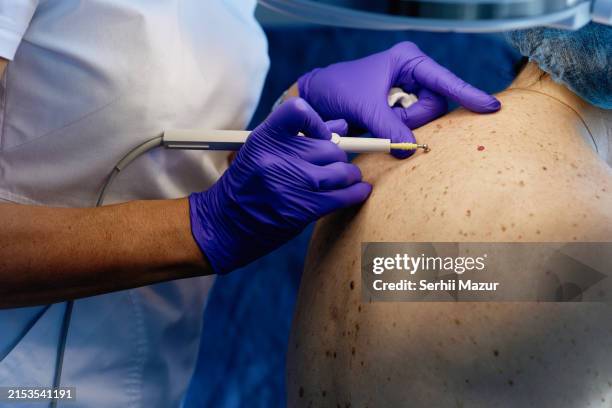 dermatological skin examination - stock photo - biopsia imagens e fotografias de stock