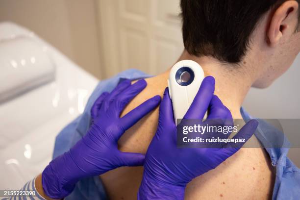 dermatóloga examinando a su paciente con un dermatoscopio - melanoma fotografías e imágenes de stock