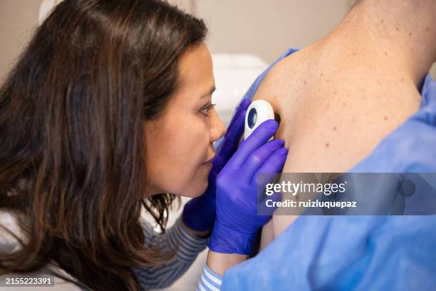 female dermatologist examining her patient with a dermatoscope - hudcancer bildbanksfoton och bilder
