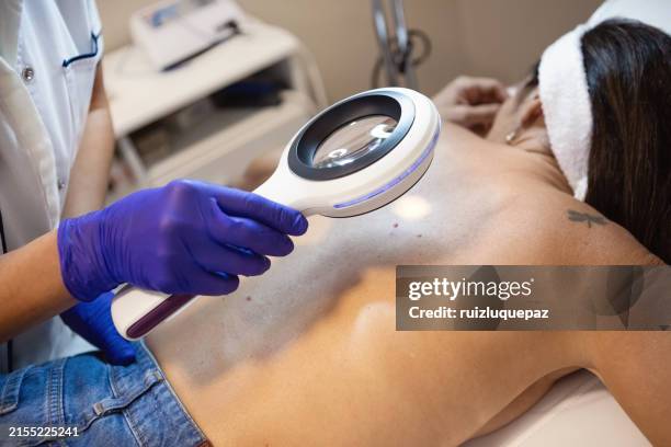 dermatóloga examinando a su paciente con una lupa dermatológica - melanoma fotografías e imágenes de stock
