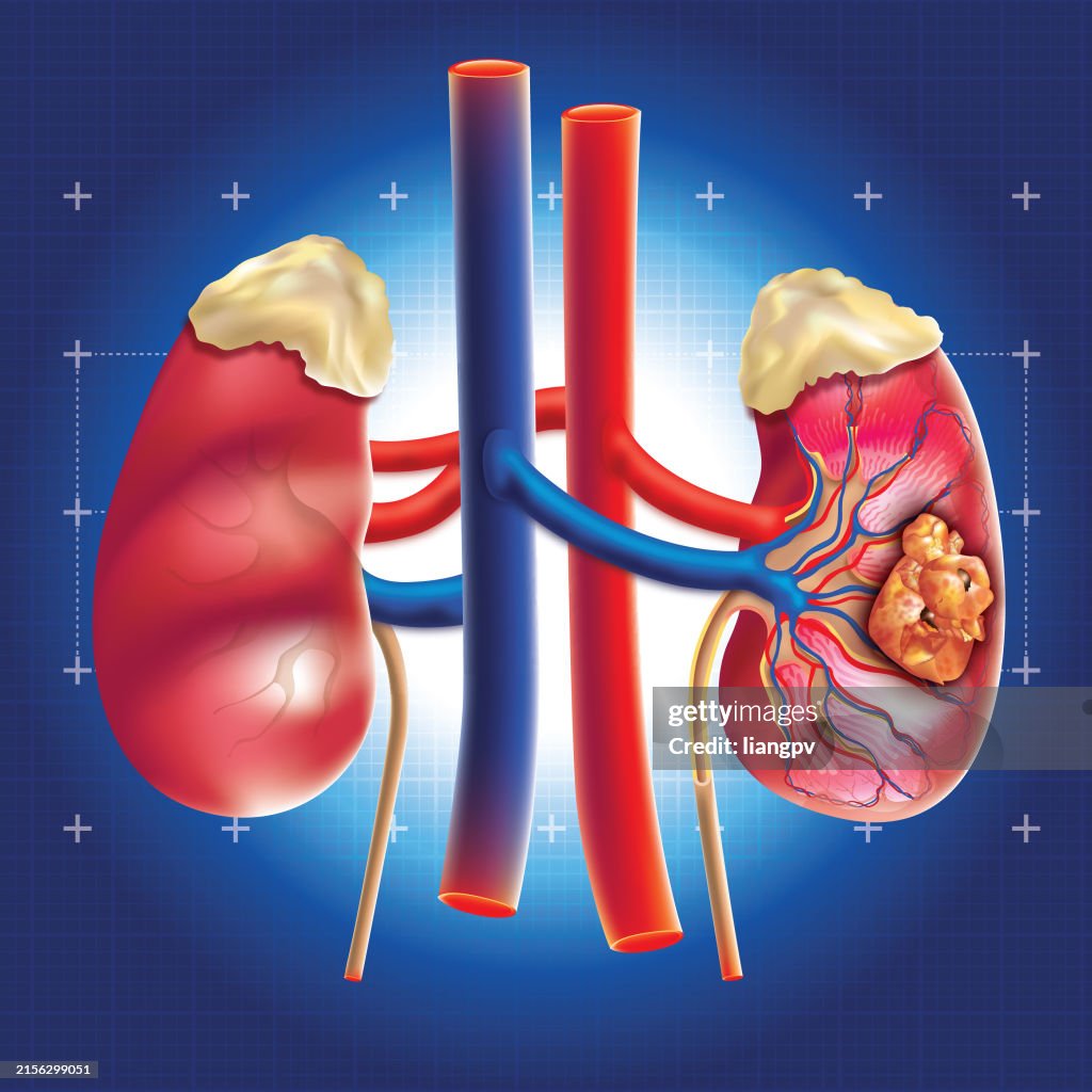 Kidney cancer