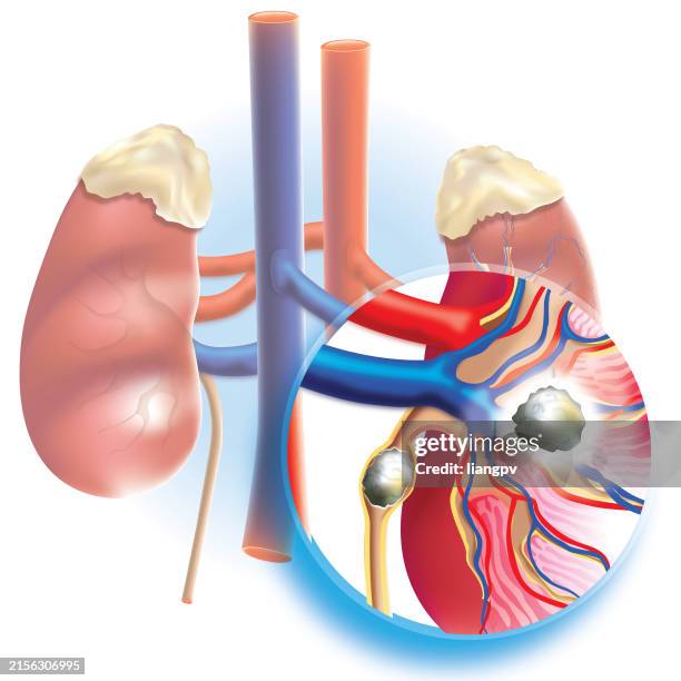 human kidney stone - lithotripsy stock illustrations