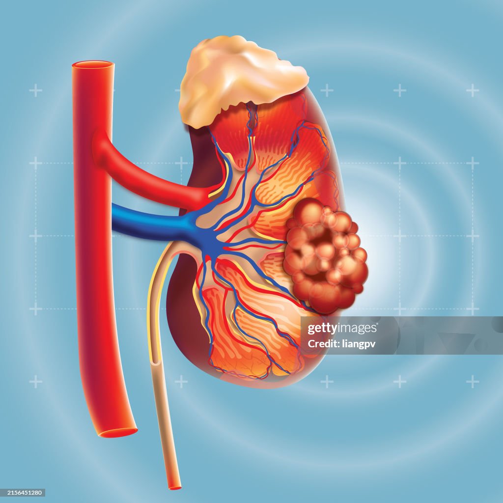 Kidney cancer