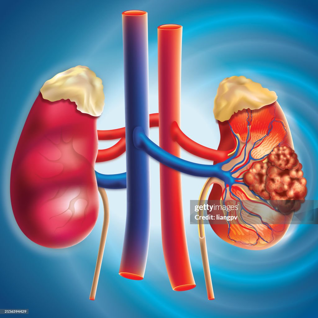 Kidney cancer