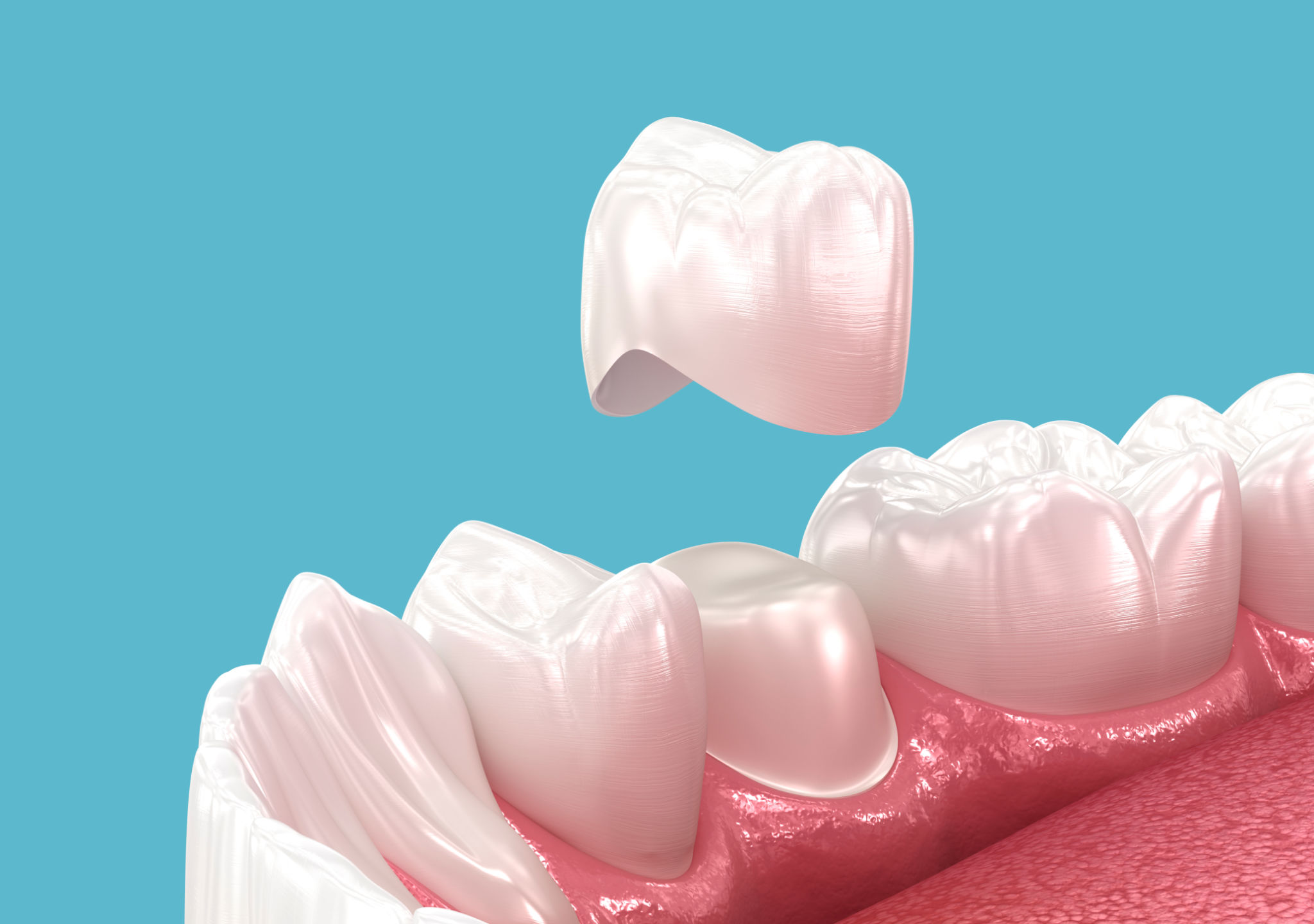 tooth crown