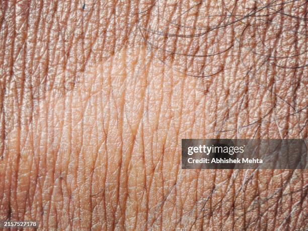 Bad Skin Example 777 Bad Skin Texture Stock Photos, High-Res Pictures, and Images ...