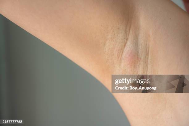 close up of woman having swollen axillary lymph nodes under her armpit. - swollen stock pictures, royalty-free photos & images