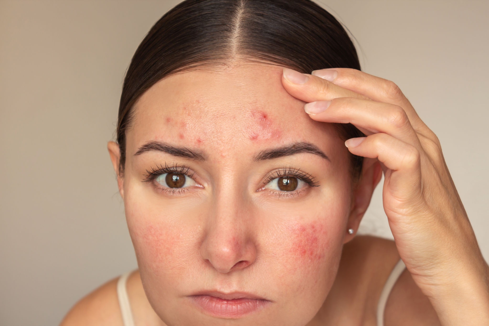Young caucasian woman looking at camera and examines pimples on her forehead. Young caucasian woman looking at camera and examines pimples on her forehead.