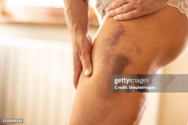 bruise on the leg of an unidentified woman after domestic violence. - cardenal lesión física fotografías e imágenes de stock