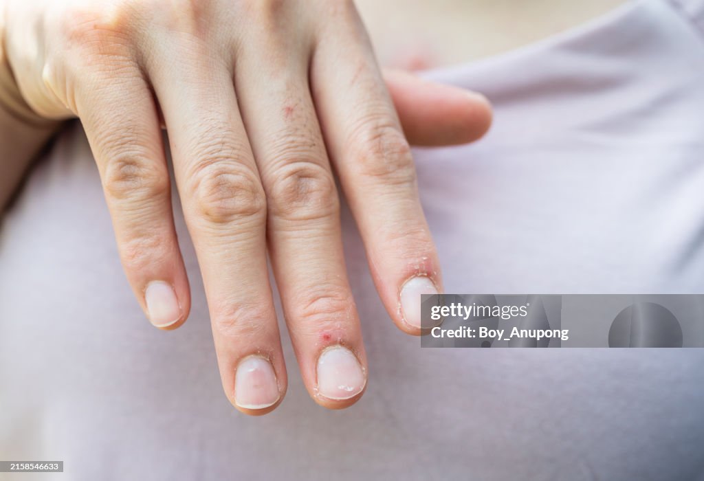 Cropped shot view of woman having hand Eczema problem.