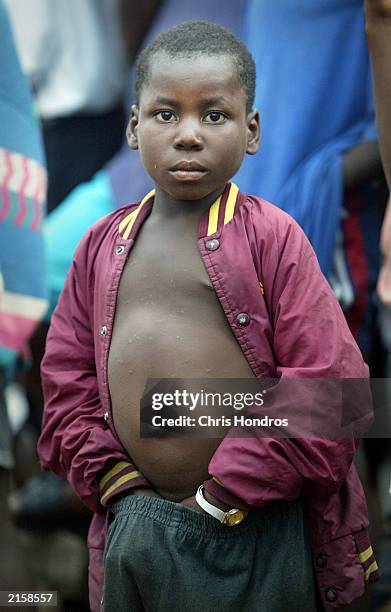Distended Distended Abdomen Photos and Premium High Res Pictures - Getty Images