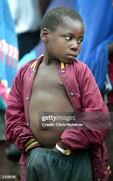 Distended 25 Distended Abdomen Stock Photos, High-Res Pictures, and Images ...