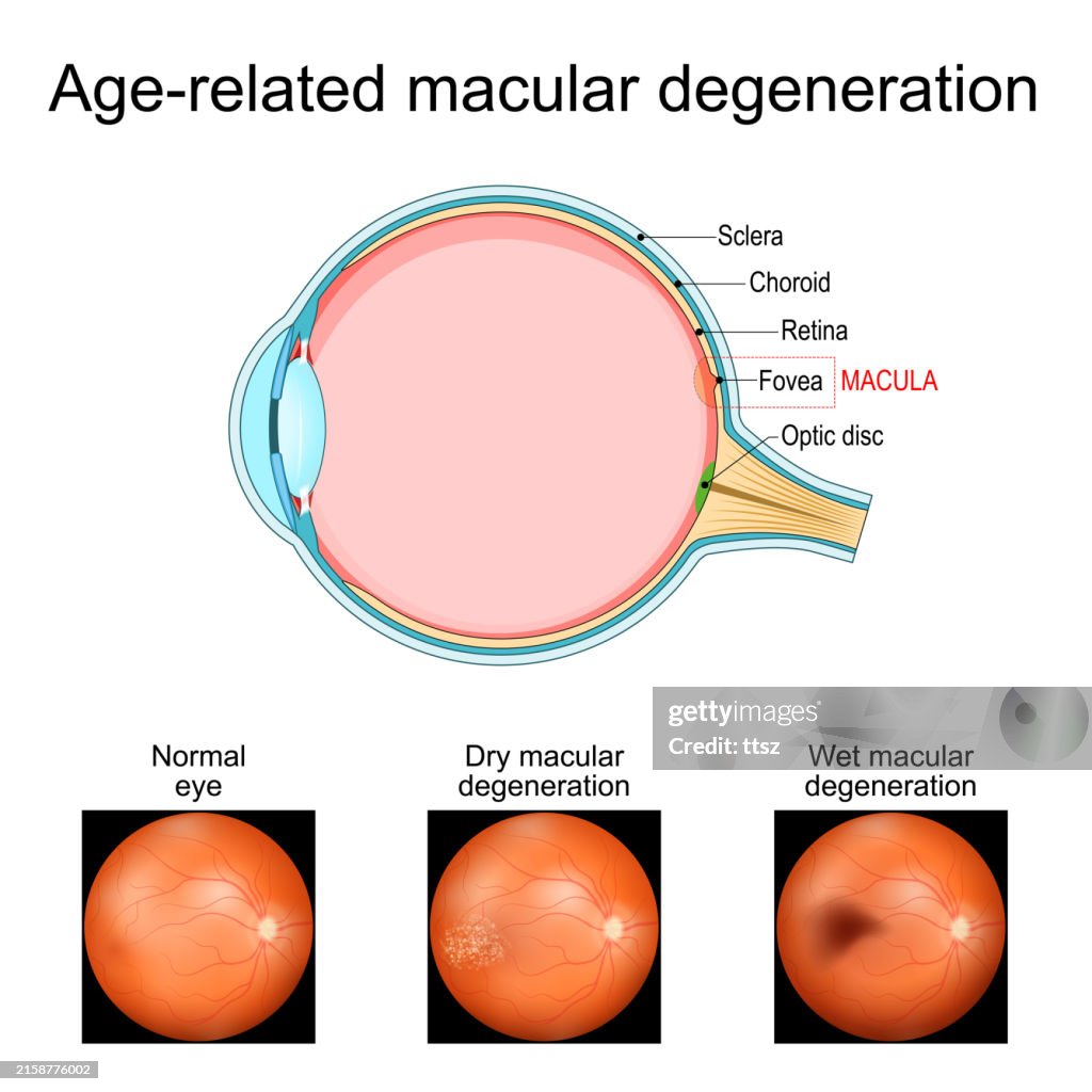 Agerelated Macular Degeneration Cross Section Of Human Eye High Res agerelated-macular-degeneration-cross-section-of-human-eye-high-res