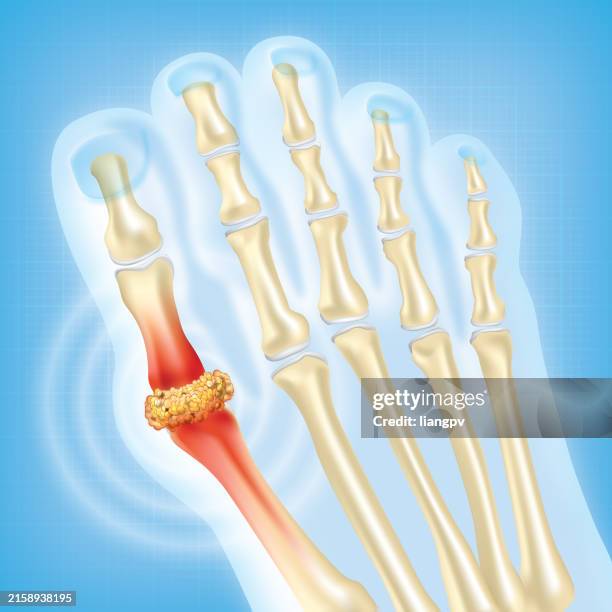 illustrations, cliparts, dessins animés et icônes de gout - goutte condition médicale