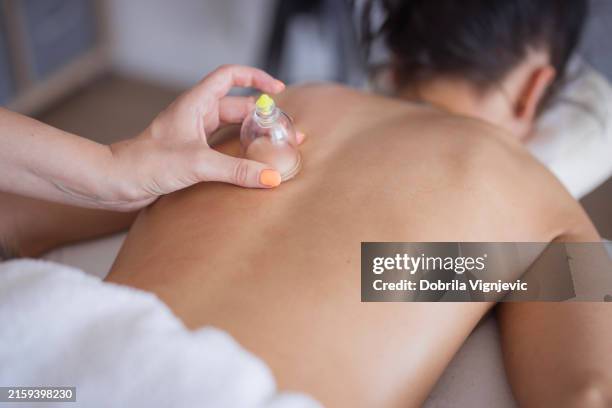 therapist beginning cupping therapy - cupping stockfoto's en -beelden