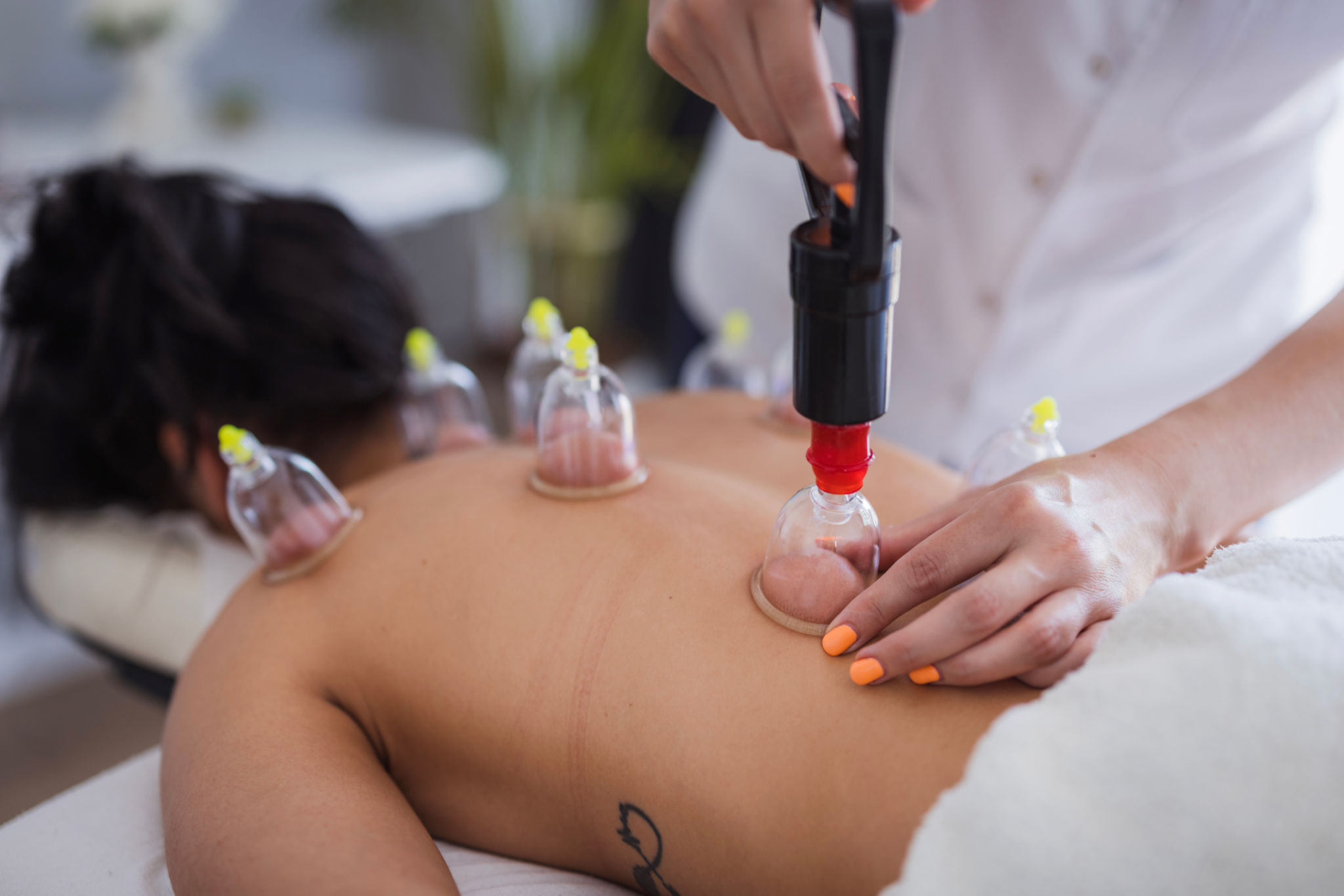 cupping therapy