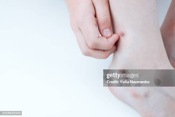 mosquito bites and bruises on the skin. - mosquito bite stock pictures, royalty-free photos & images