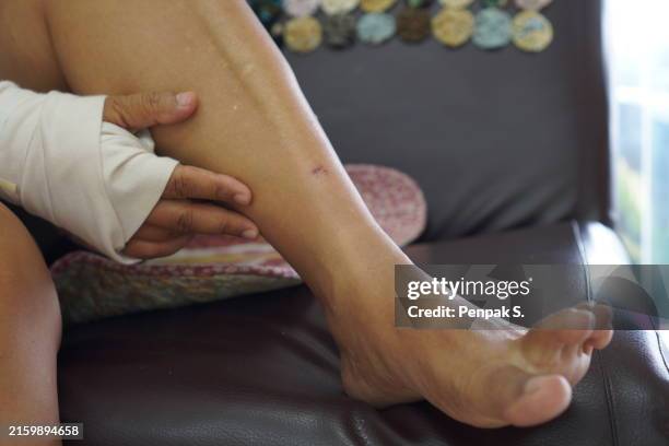 Shin Rish 153 Eczema Legs Stock Photos, High-Res Pictures, and Images - Getty Images