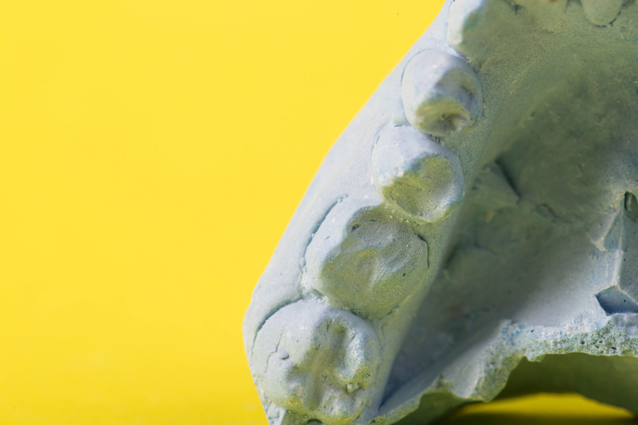dental bridge types