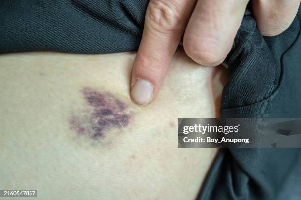 cropped shot view of bruise occur on human skin. bruising can occur more easily as we age due to thinning of the skin. - purple spots on legs stock pictures, royalty-free photos & images