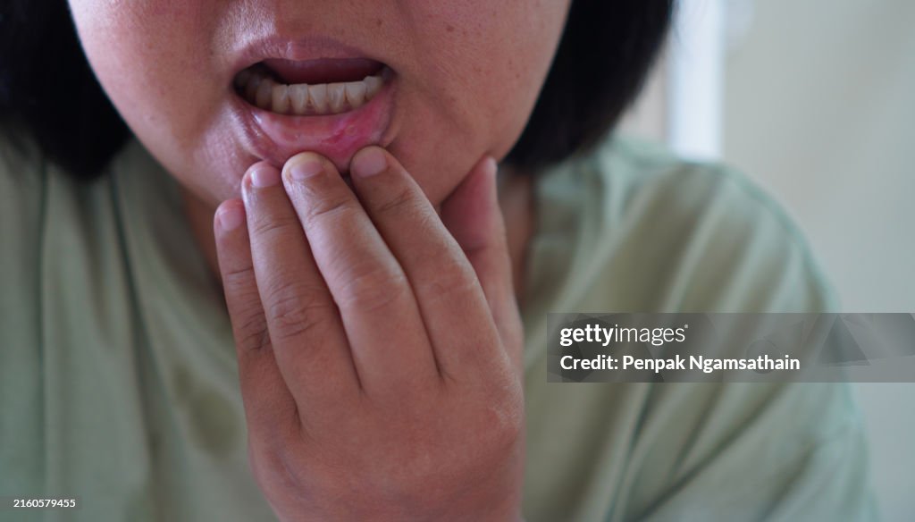Aphthous ulcer
