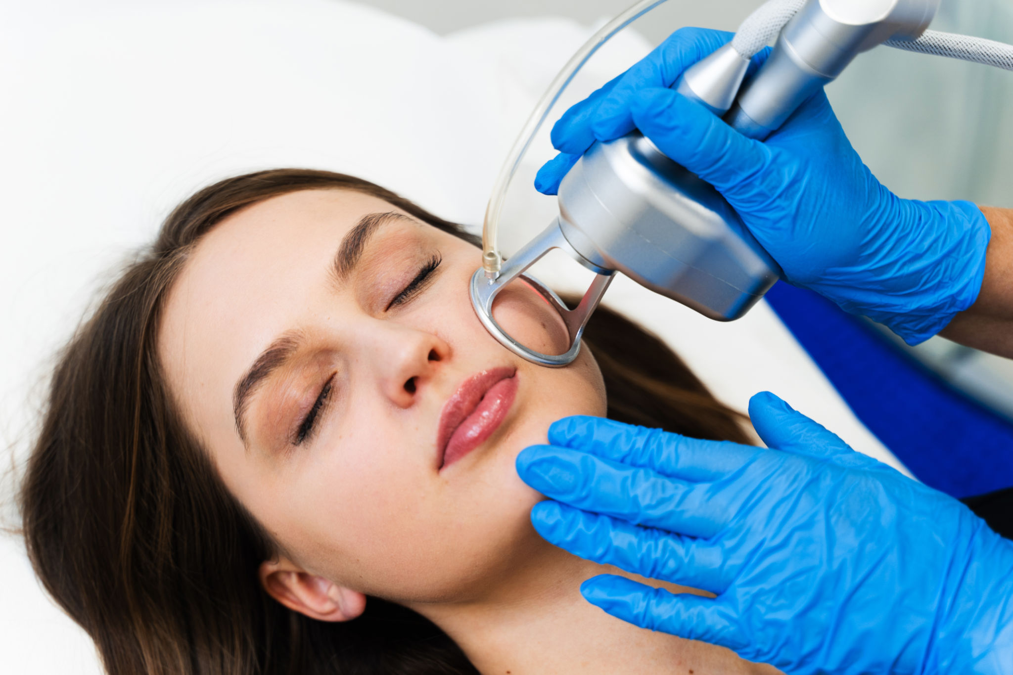 laser resurfacing