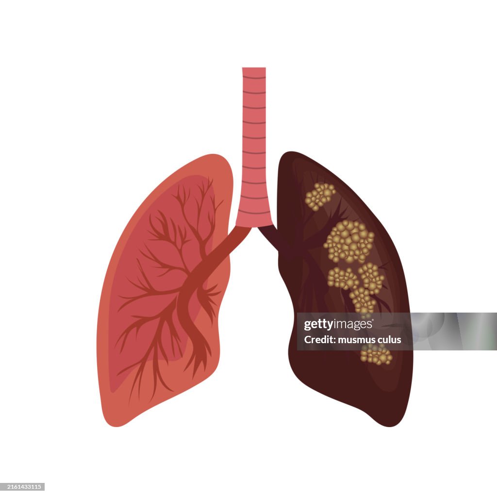 Ilustración de pulmones sanos y enfermos