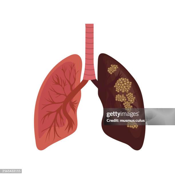 bildbanksillustrationer, clip art samt tecknat material och ikoner med illustration of healthy and diseased lungs - lunga