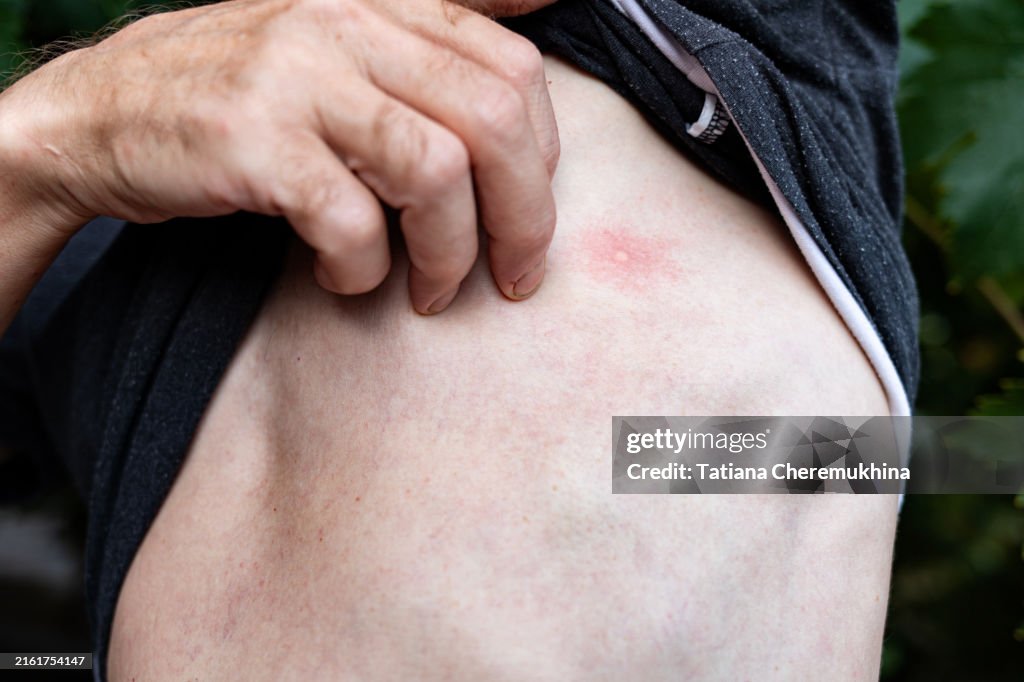 A mosquito bite on the torso of a fair-skinned man.