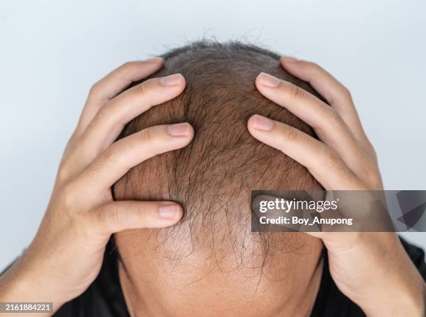 cropped shot view of asian men having stress becaused of hair loss problem. baldness is related to your genes and male sex hormones. - symptom stock pictures, royalty-free photos & images